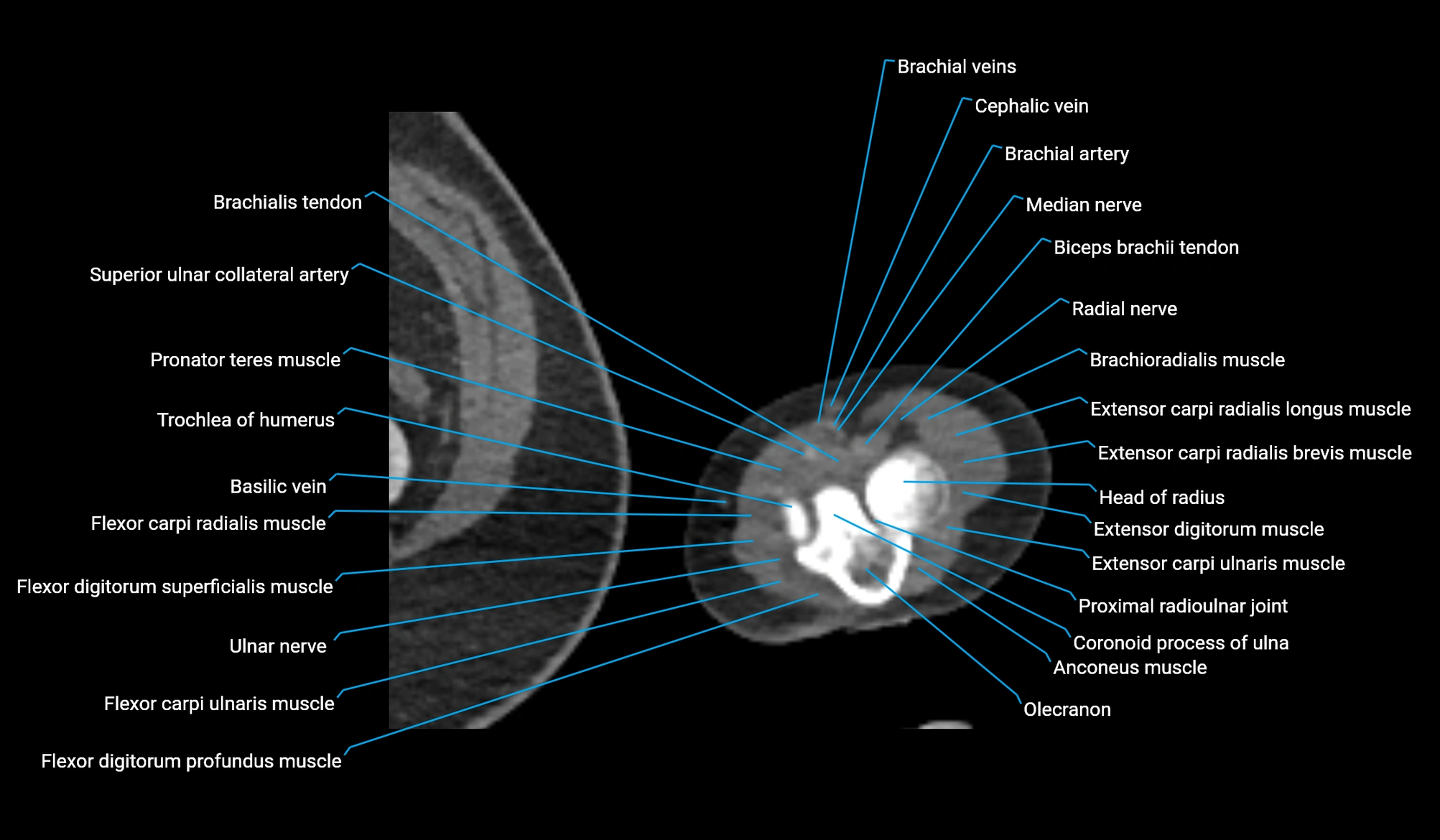 CT upper arm axial  cross sectional anatomy labelled radiology image -00400.webp